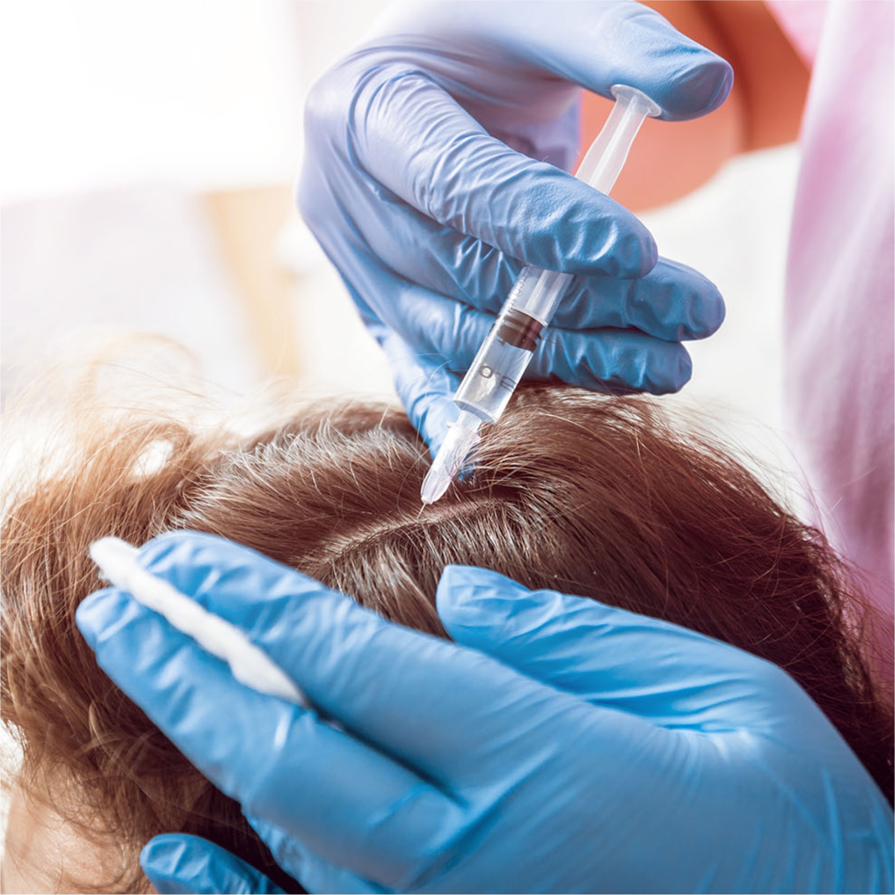 آخرین نتایج علمی نشان دهنده تاثیر مثبت پلاسمای غنی از پلاکت   (PRP) در درمان ریزش مو می باشد